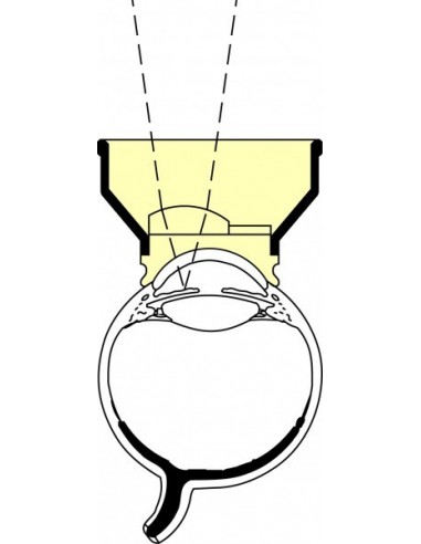 VERRE OCULAR ABRAHAM IRIDECTOMIE  YAG OAIY