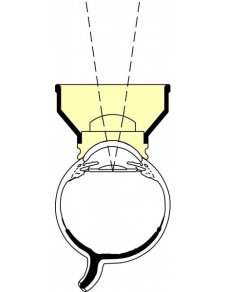 VERRE OCULAR ABRAHAM DIAG & LASER CAPSULOTOMIE (YAG) OAYA