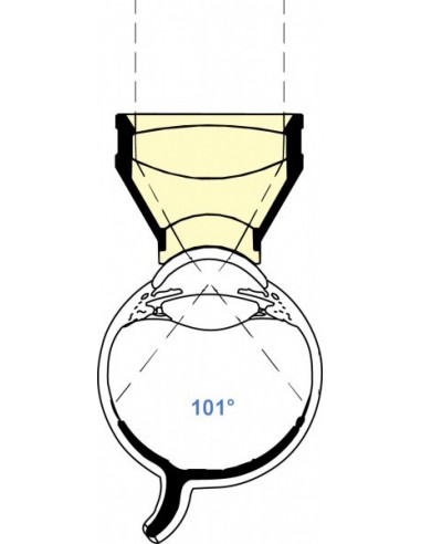 OCULAR LANDERS EQUATORIAL II VITRECTOMY LENS (OLIV-EQ-2)