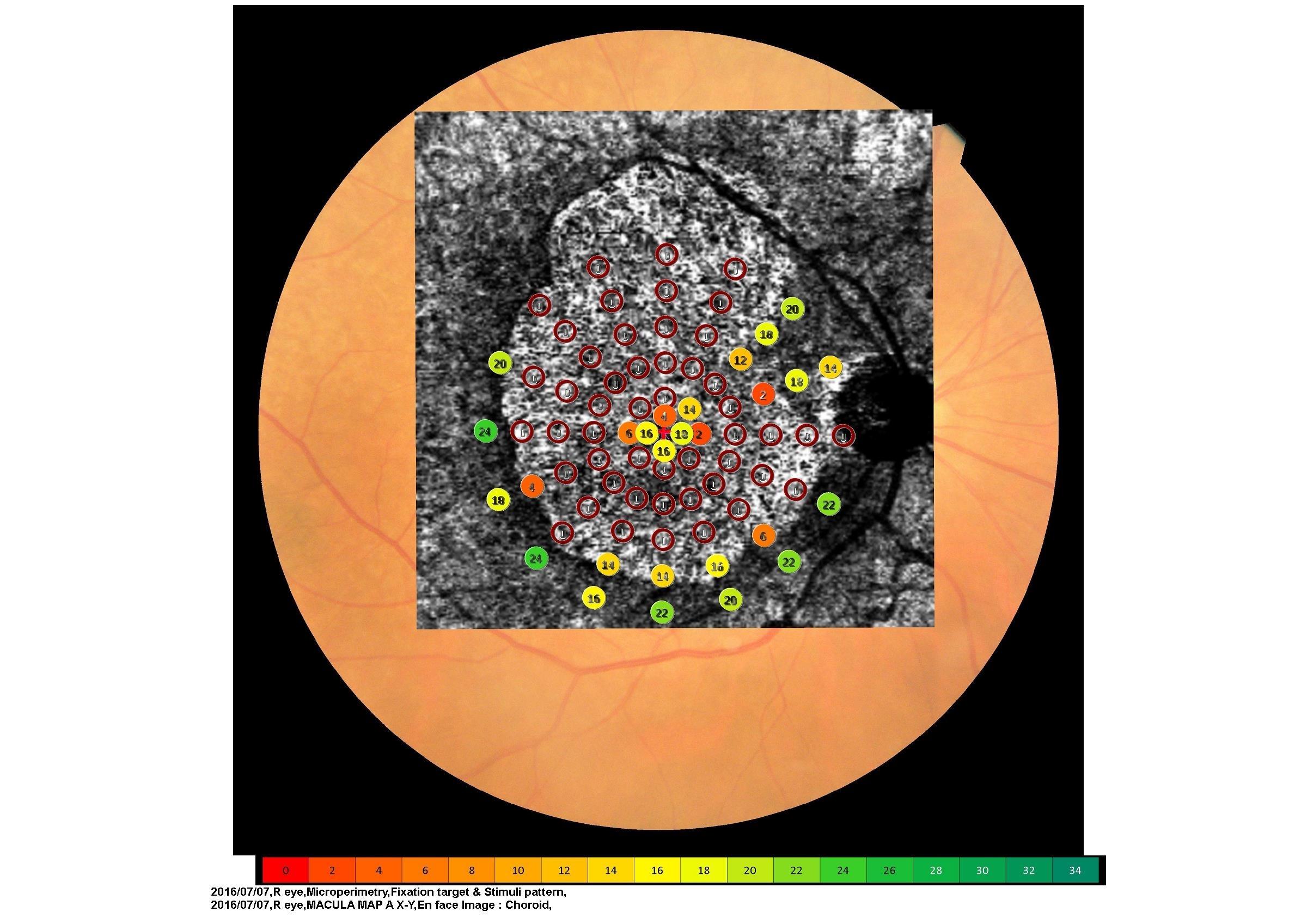 Superposition des résultats de micropérimétrie (MP-3) à ceux d’OCT-Angiographie (RS-3000 Advance 2) et de photographie du fond d’œil (MP-3)