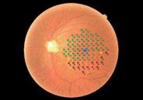 Résultat de micropérimétrie – Œil glaucomateux