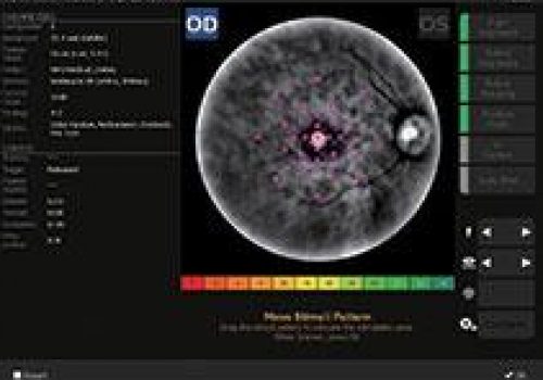 Micropérimétrie avec Auto Tracking et Auto alignement