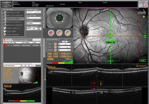 Examen de Follow-Up avec reconnaissance de la rétine et repositionnement du scan