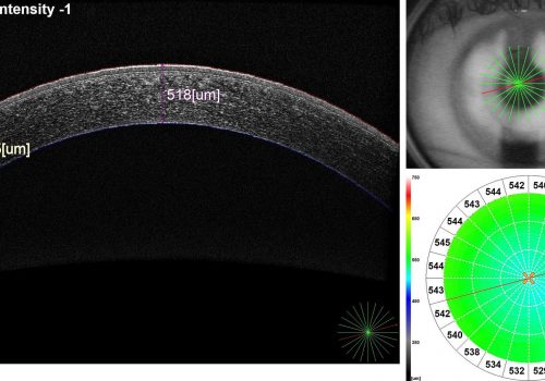 Cartographie d’épaisseur de la cornée