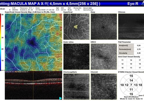 Analyse OCT-A sur Macula – 7 segmentations avec valeurs de densité vasculaire et zone avasculaire centrale