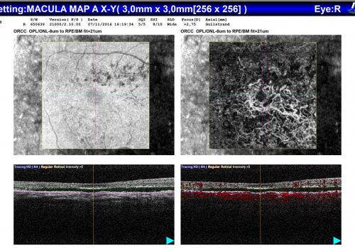 Analyse comparative OCT En Face / OCT-A / B-scan sur Macula