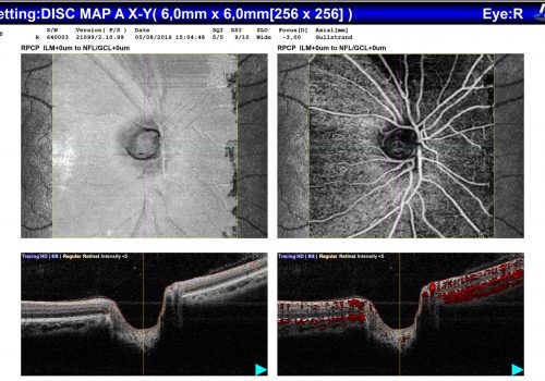 Analyse comparative OCT En Face / OCT-A / B-scan sur Papille