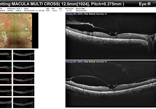 Résultat du Macula Multi OD