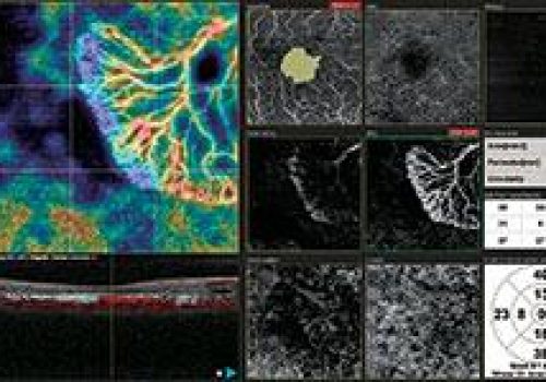 Analyse d’OCT-Angiographie sur macula