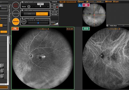 Ecran d’acquisition an angiographie simultanée FA et ICG avec IR en temps réel