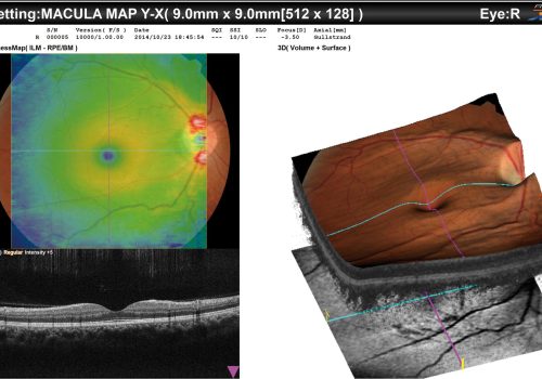 Représentation en 3D du Macula Map