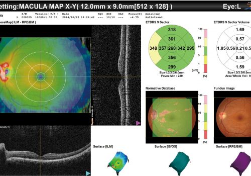 Analyse du cube 3D ligne par ligne (Macula)