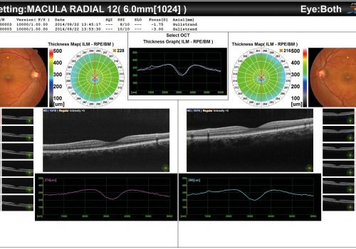 Résultat du Macula Radial OD/OG