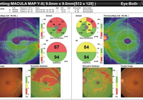 Epaisseur du complexe des cellules ganglionnaires avec BDN sur 9x9mm (Glaucome)