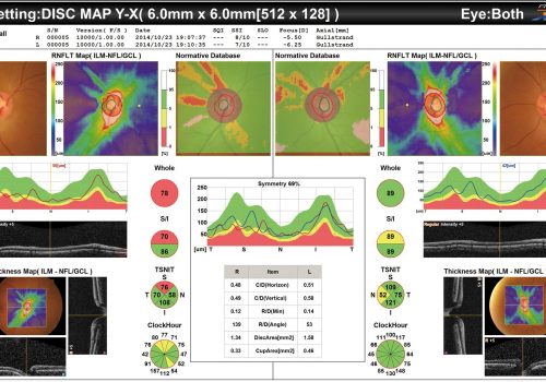 Cartographie RNFL avec BDN sur 6x6mm (Glaucome)