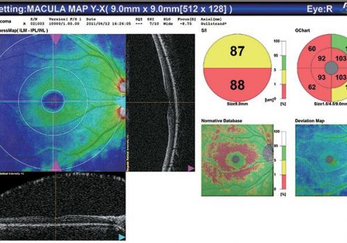 Analyse du cube 3D ligne par ligne (Macula)