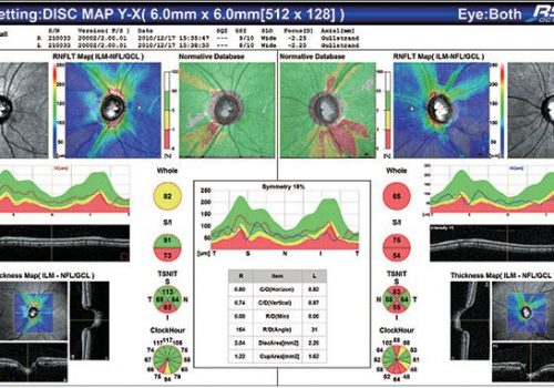 Cartographie RNFL avec BDN sur 6x6mm (Glaucome)