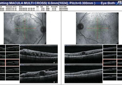 Résultat du Macula Multi OD/OG