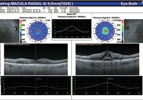 Résultat du Macula Radial OD/OG avec épaisseur de rétine