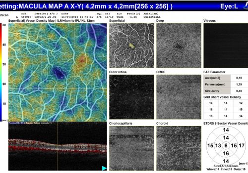 Analyse OCT-A sur Macula – 7 segmentations