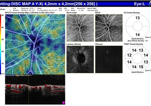 Analyse OCT-A sur Papille – 4 segmentations