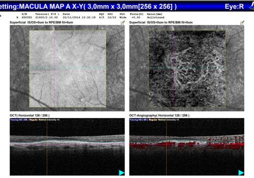 Analyse comparative OCT En Face / OCT-A / B-scan sur Macula