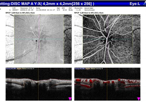 Analyse comparative OCT En Face / OCT-A / B-scan sur Papille