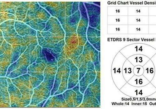 Analyse quantitative de densité vasculaire sur Macula