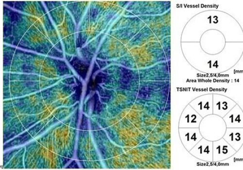 Analyse quantitative de densité vasculaire sur Papille