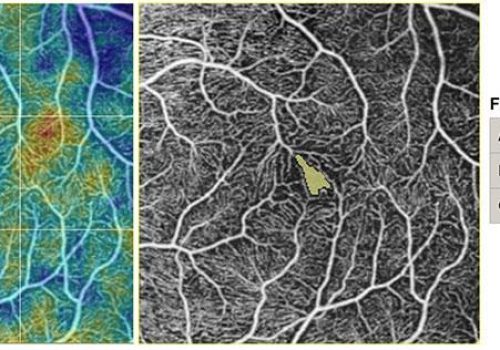 Analyse quantitative sur la zone avasculaire centrale