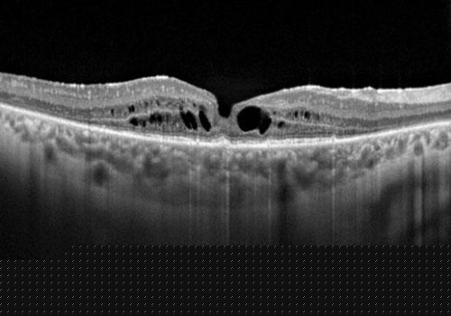 Coupe B-scan HD 120 en mode choroïde (EDI)