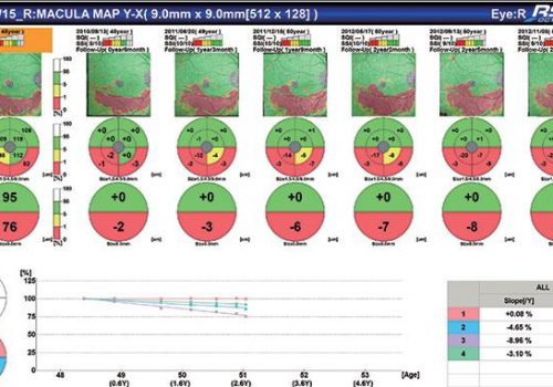 Analyse Follow-Up comparative sur Macula Map, complexe des cellules ganglionnaires
