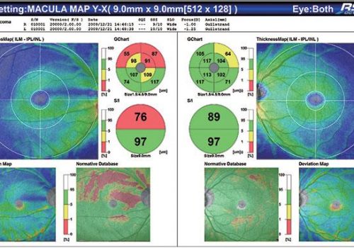 Epaisseur du complexe des cellules ganglionnaires avec BDN sur 9x9mm (Glaucome)