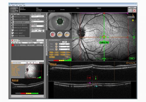 Examen de Follow-Up avec reconnaissance de la rétine et repositionnement du scan